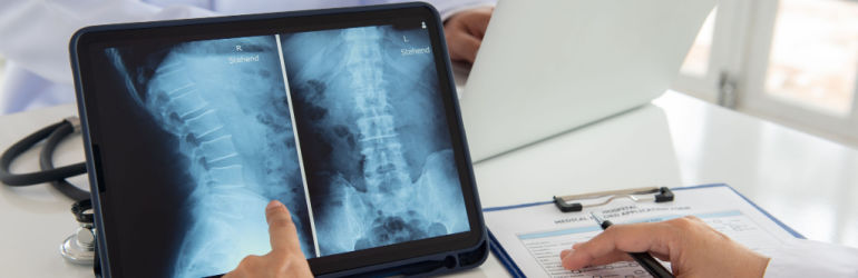 Herniated Disc
