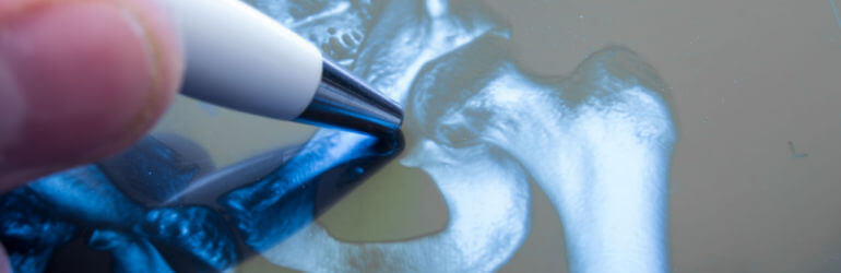 depuy pinnacle lawsuit