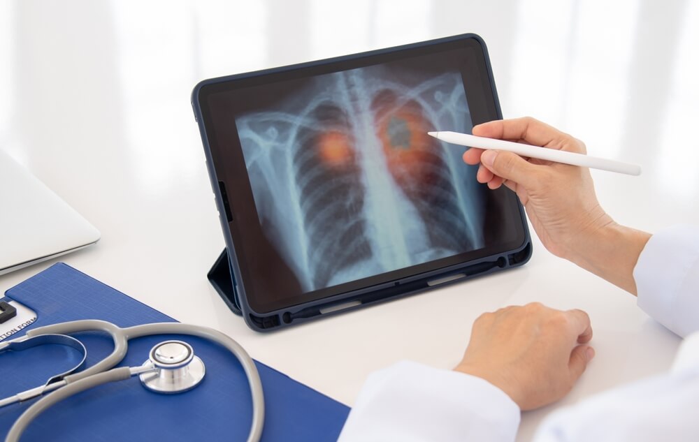 Doctor reviewing lung cancer X-ray on tablet, highlighting asbestos exposure diagnosis for legal case evaluation