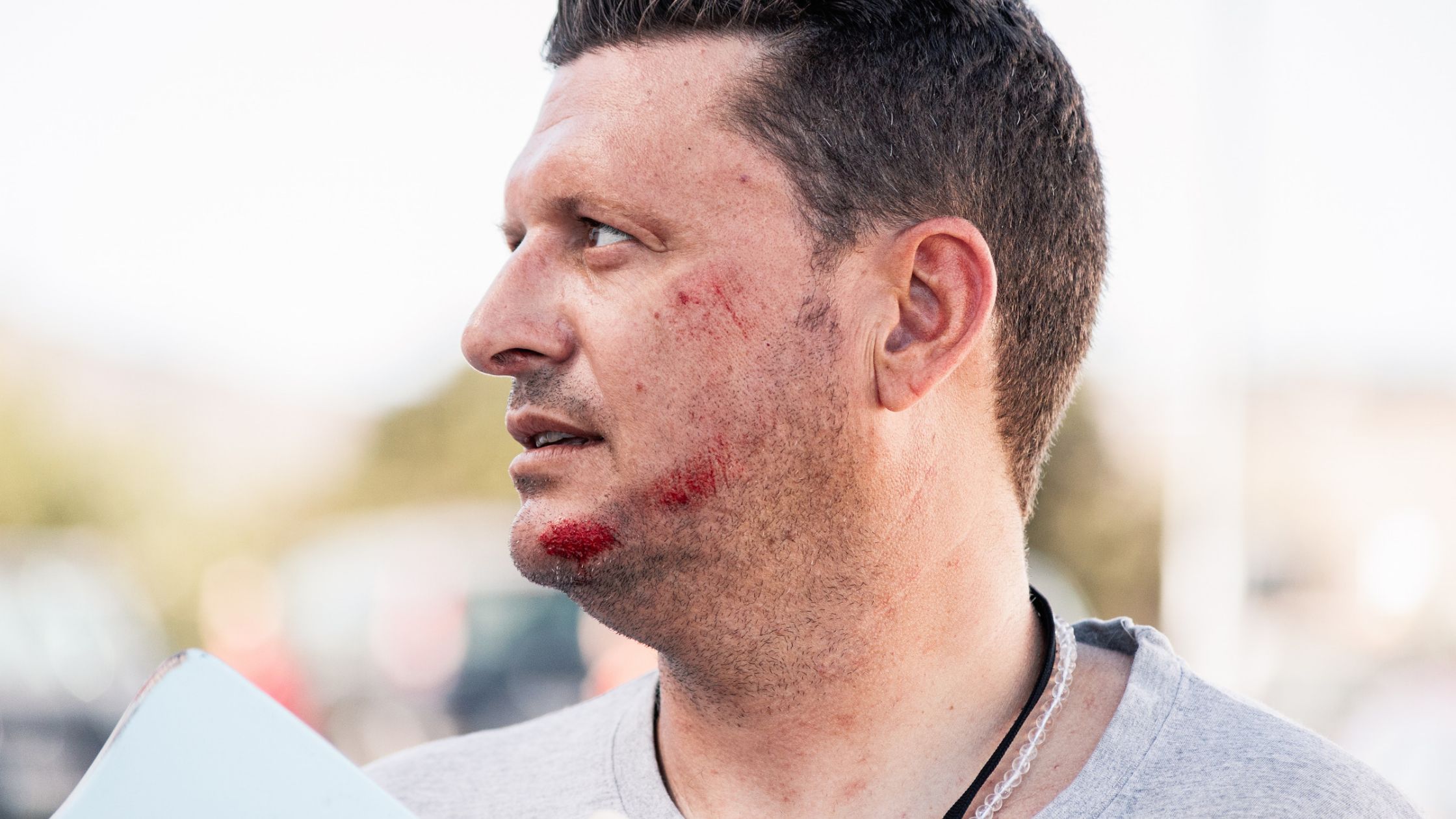 Greensboro Facial Injury Lawyer